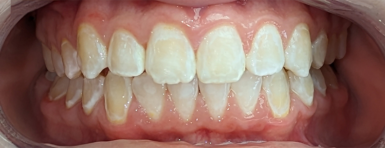Patient3_After